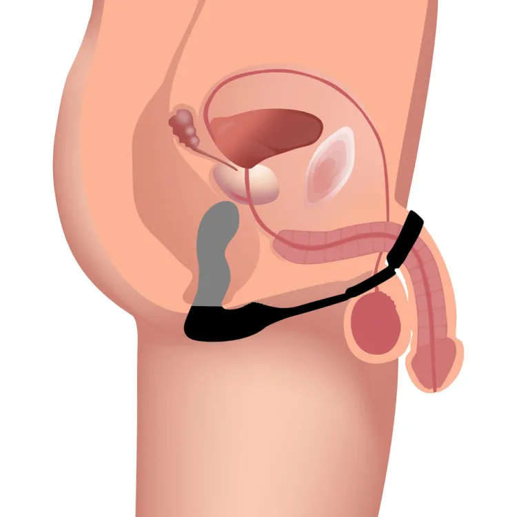 Swell Prostate Massagers | Penis Rings>10X Inflatable and Vibrating Prostate Plug with C&B Ring